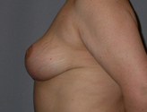 Patient # 82406 After Photo # 6